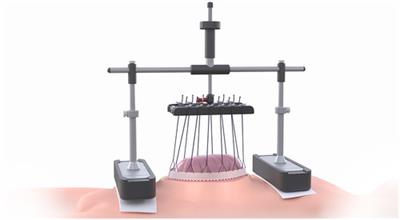 Evaluating a novel vertical traction device for early closure in open abdomen management: a consecutive case series